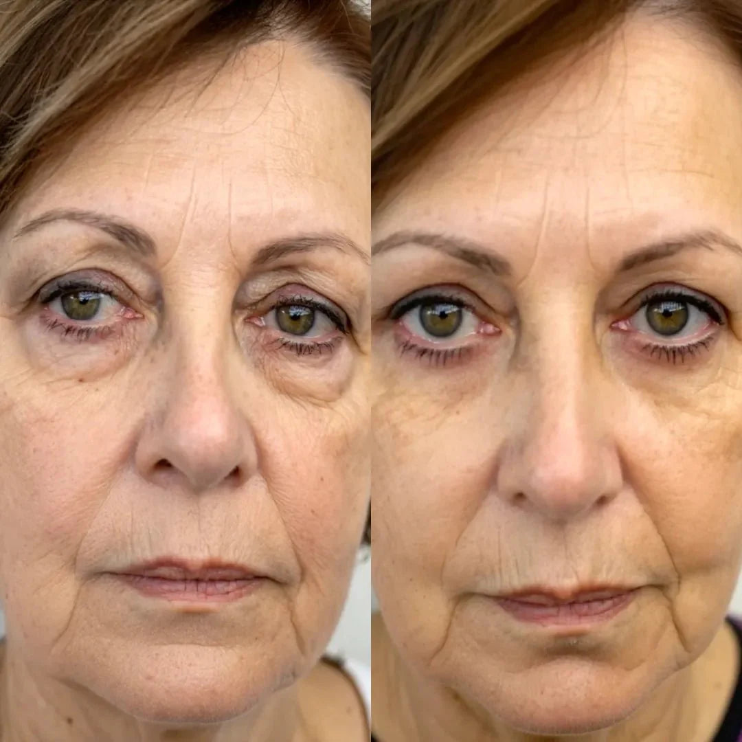 AloraEyes® 2-in-1 Red Light Therapy + EMS To Erase Eye Bags
