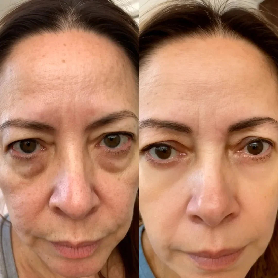 AloraEyes® 2-in-1 Red Light Therapy + EMS To Erase Eye Bags