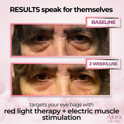 AloraEyes® 2-in-1 Red Light Therapy + EMS To Erase Eye Bags