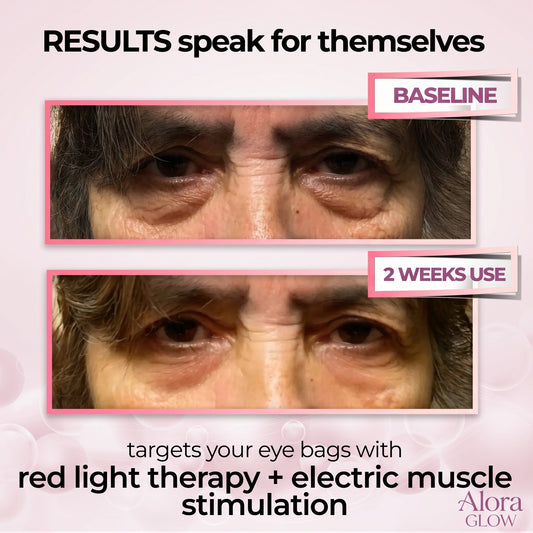 AloraEyes® 2-in-1 Red Light Therapy + EMS To Erase Eye Bags